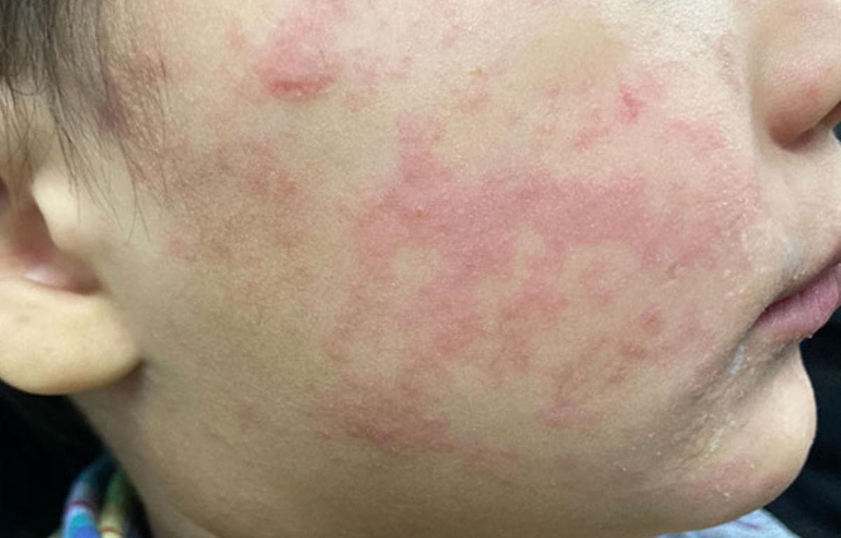 Buncombe Confirms Sixth Measles Case; Possible Exposures at Food Lion, Mission Hospital