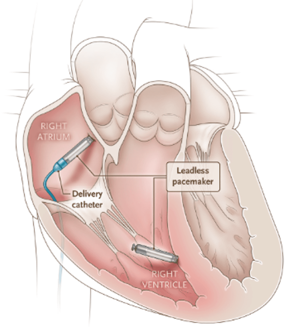 Mission Hospital First in WNC to Implant Leadless Dual-Chamber Pacemaker