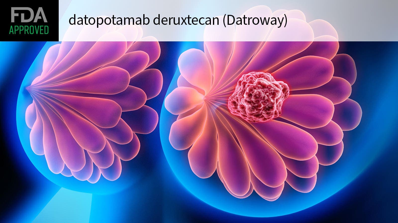 New Datroway Therapy Extends Survival for Agggressive Triple-Negative Breast Cancer