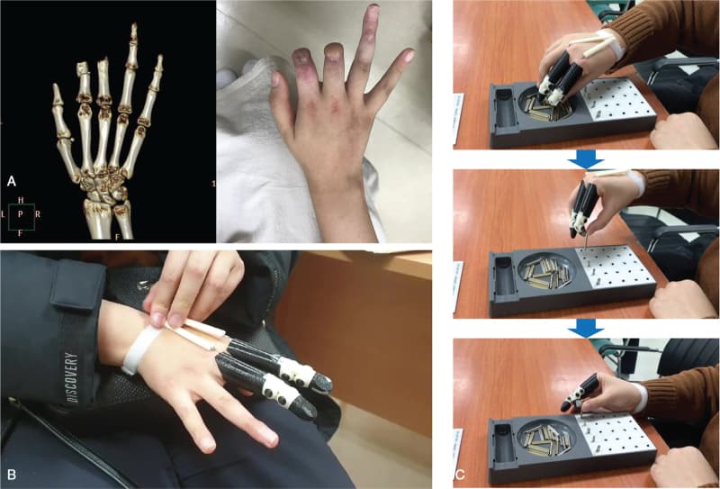 Low-cost, Rapid, Customizable Body-powered 3D-Printed Finger Prostheses Show Clinical Promise