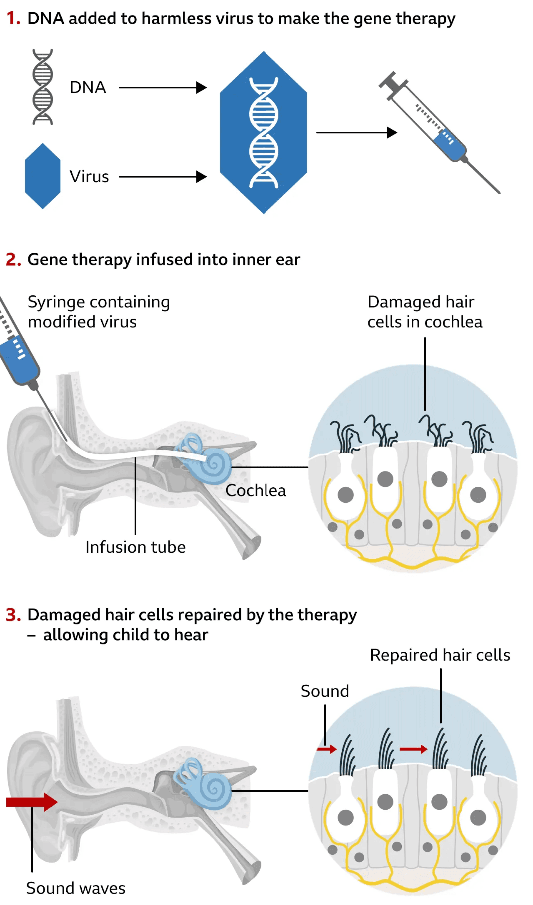 Elbridge siblings hear for first time after FDA-approved gene therapy