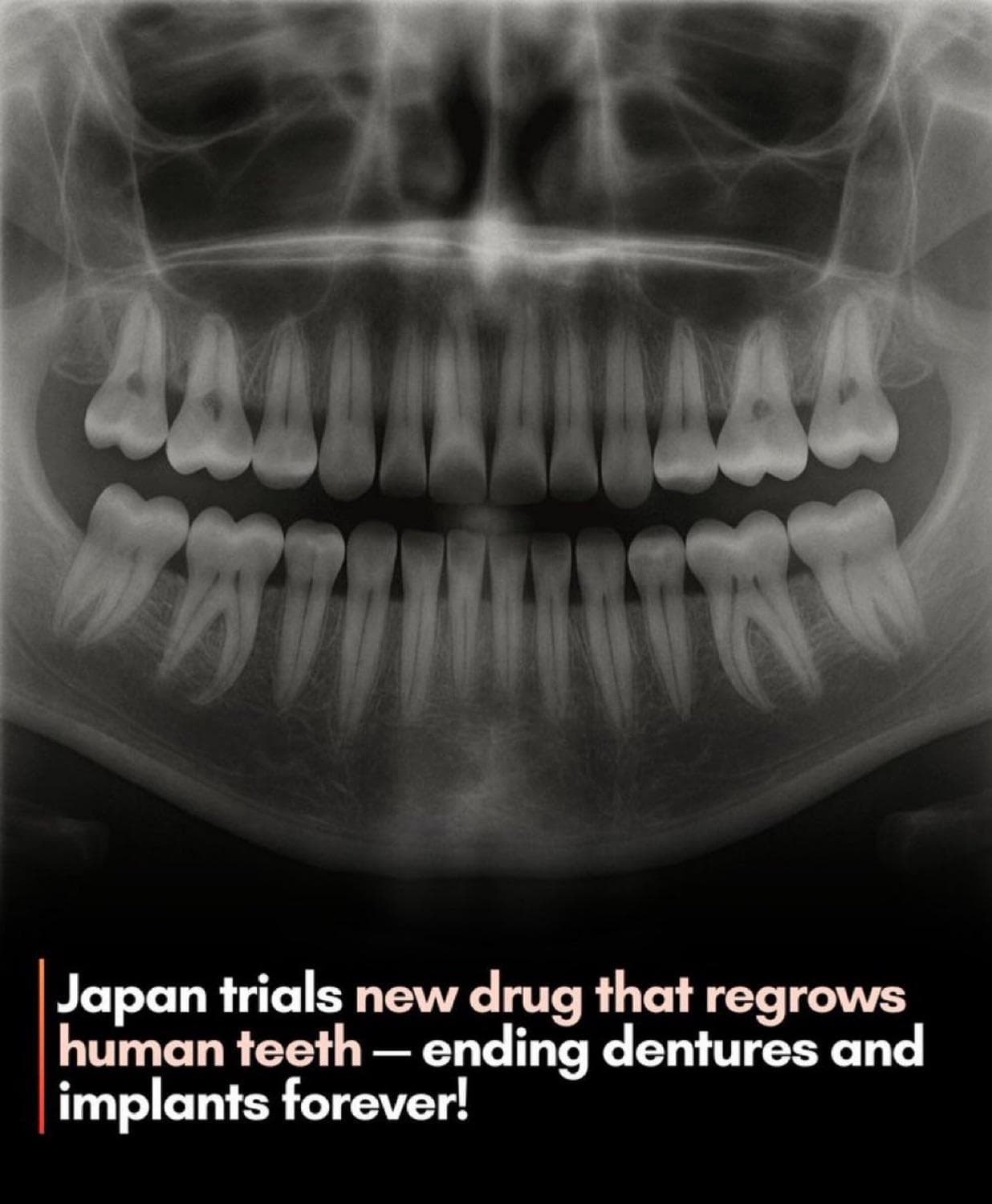 Japan begins human trial of drug to regrow missing teeth
