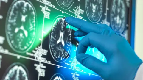 Cochrane review finds Alzheimer’s drugs offer little benefit, raise brain bleeding risk