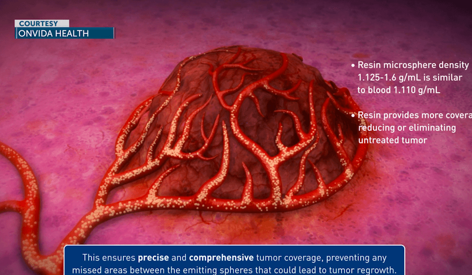 Onvida Health performs first Y-90 liver cancer treatment in Yuma County
