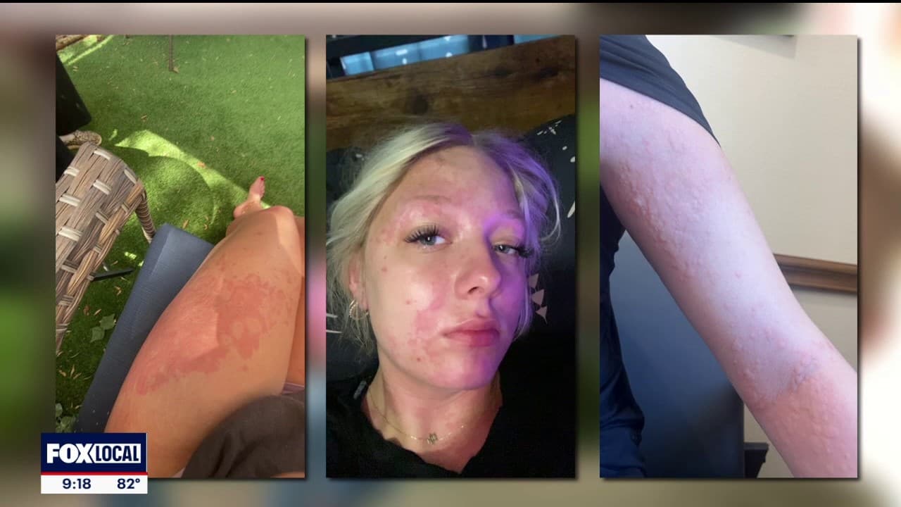 Trinidad teen hospitalized after chemical burns linked to water issues