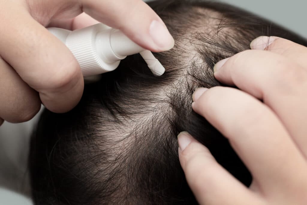 FDA warns of severe side effects from compounded hair loss treatments
