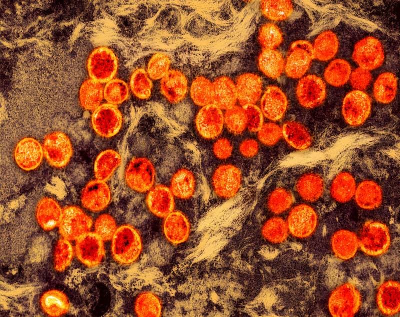 San Francisco confirms first clade I mpox case, travel-linked