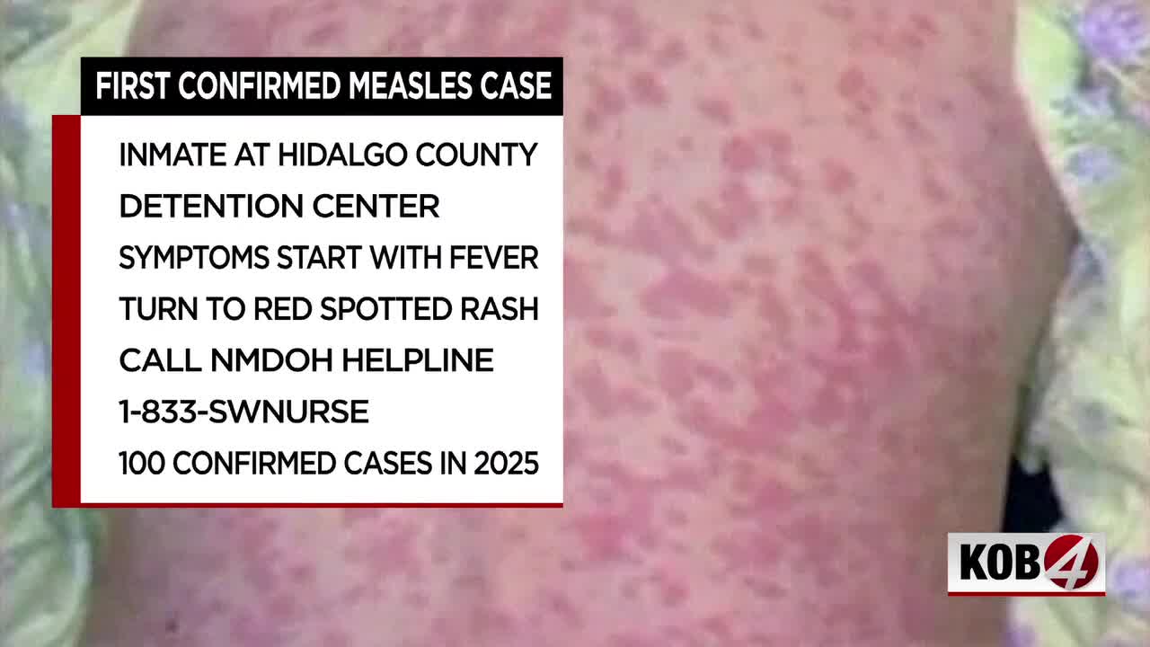 Hidalgo County detention center reports New Mexico’s first measles case of 2026