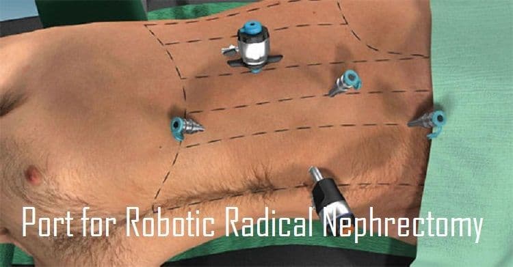 Local hospital performs rare robotic kidney cancer surgery with IVC thrombectomy