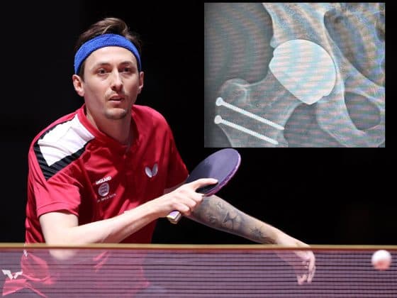 Liam Pitchford recovering after hip resurfacing surgery by Professor Damian Griffin