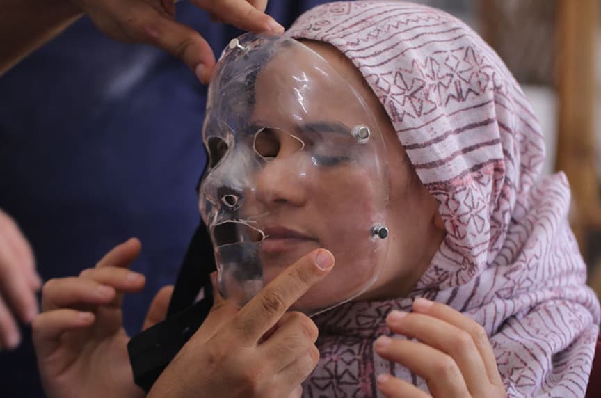 3D-printed masks help burn patients heal at Haiti’s Tabarre hospital