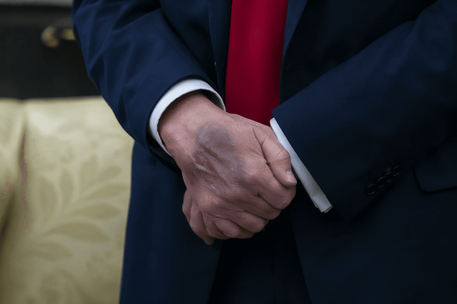 Trump's health memo says he is fit, but bruises raise questions