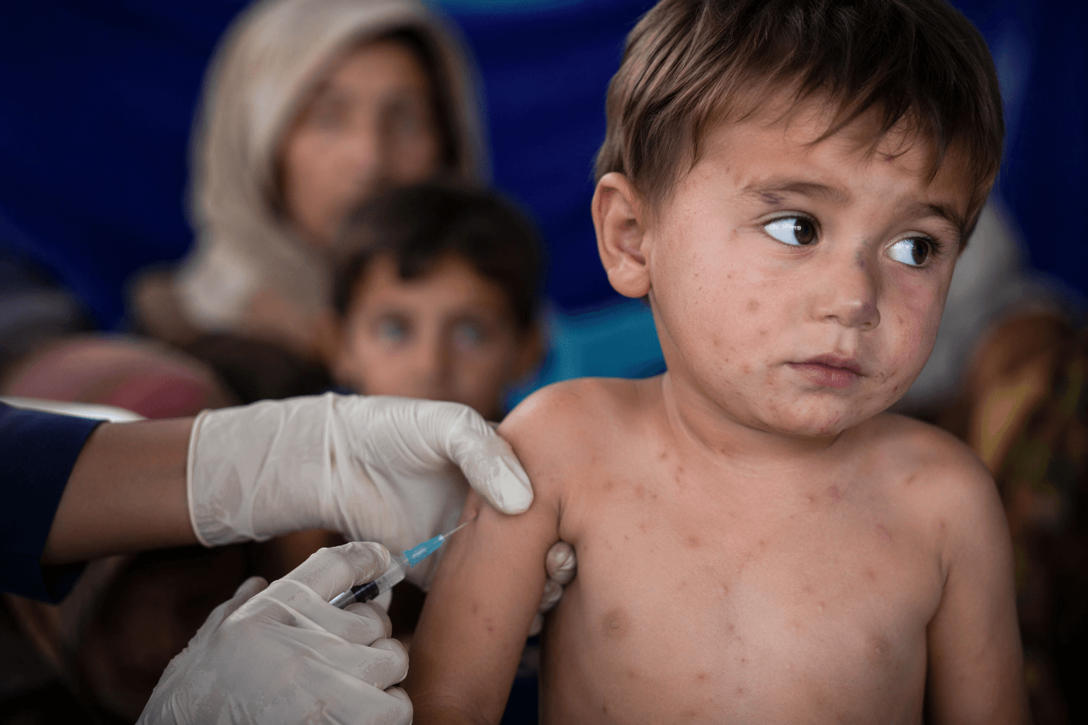 World Cup health officials worry measles more than Ebola