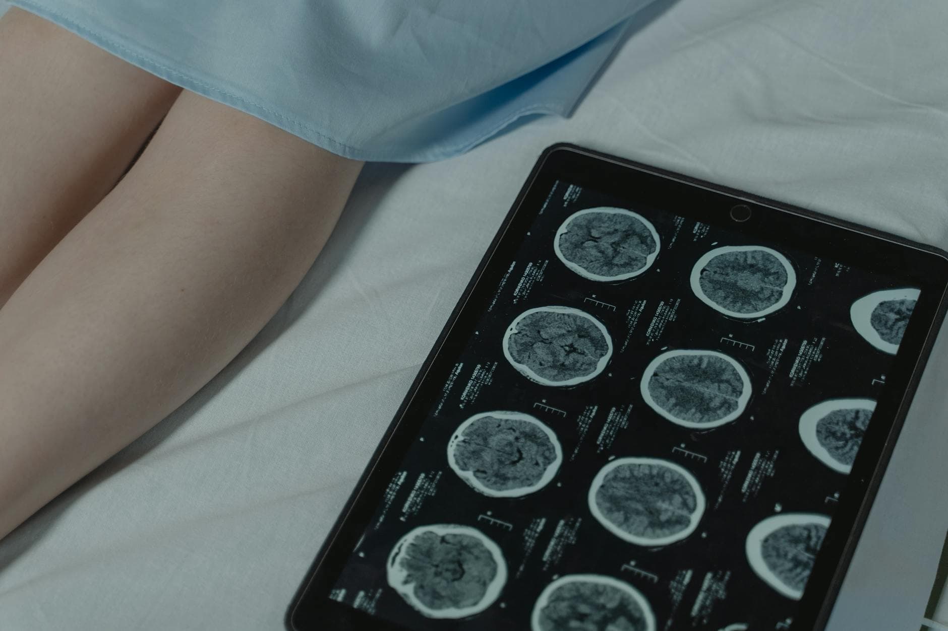 Higher vitamin D in midlife linked to less brain tau later