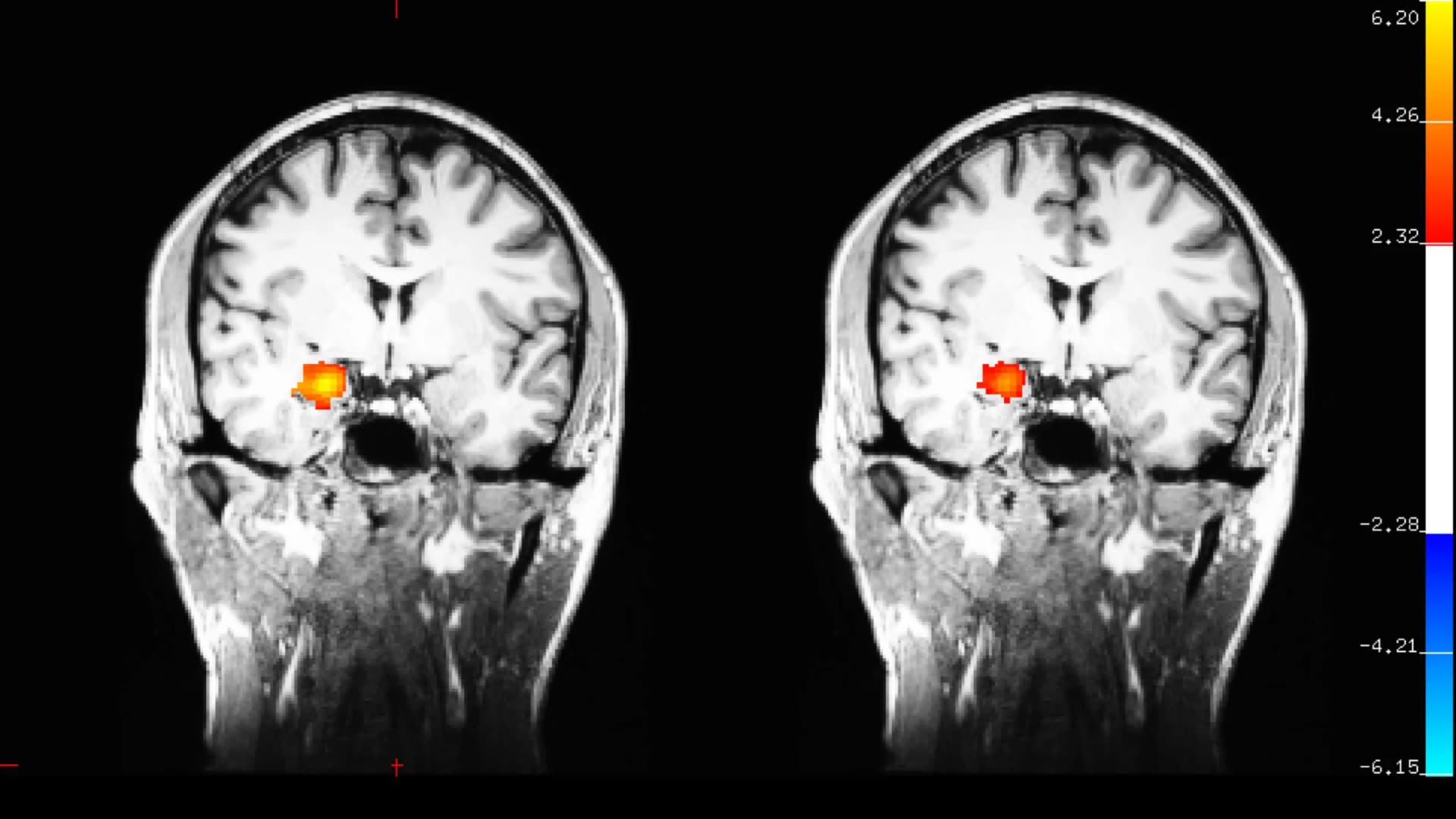 Harvard explains how advanced meditation changes the brain