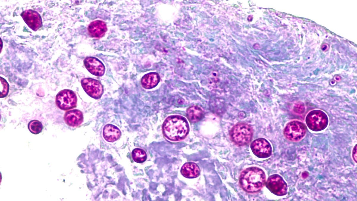 Monroe County reports first cyclosporiasis case amid statewide spike