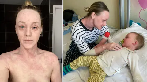 Hundreds Describe Steroid Withdrawal Skin Condition Doctors Refuse to Recognise