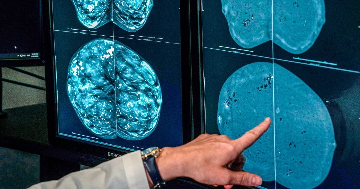 Mammogram guidelines shift as experts debate when screening should start