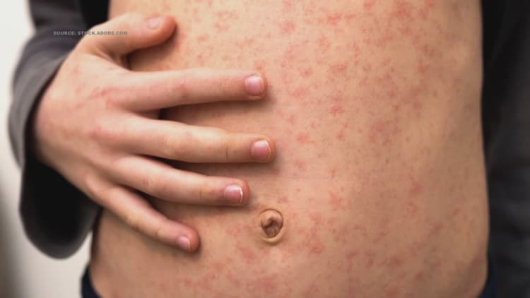 Possible Measles Exposure Reported at Greensboro Wendy's in March