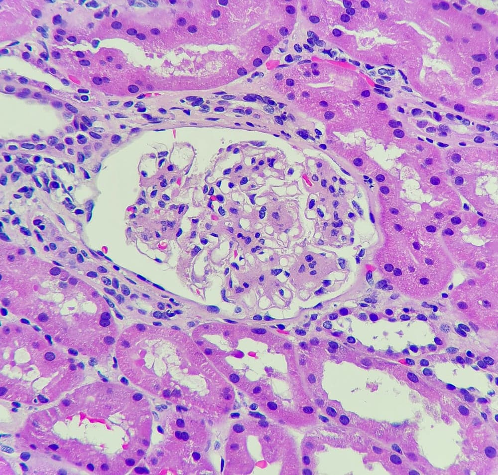 Telitacicept shows promise for IgA nephropathy in phase 3 trial